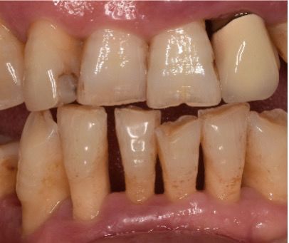 洗牙后牙缝变大了能自然恢复吗,为什么洗牙会让牙缝变大