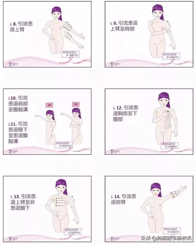 警惕！乳腺癌术后的淋巴水肿绝不能忽视