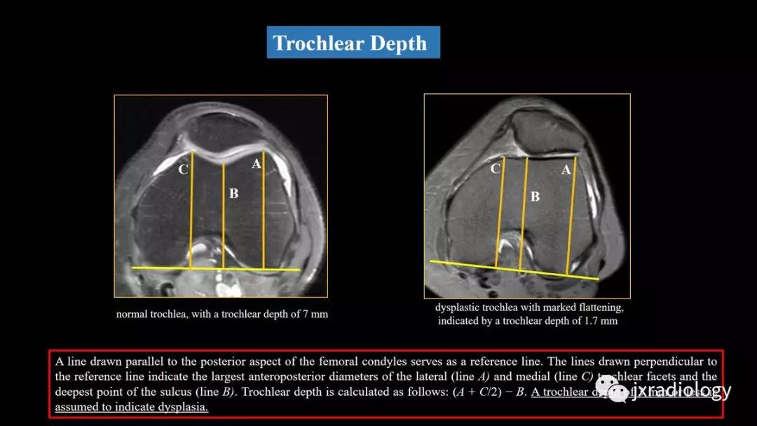 髌股关节失常磁共振看什么,髌股关节混乱的影像评估