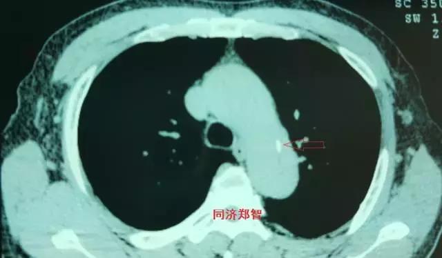 磁共振可以替代cta检查主动脉夹层,超声心动图联合cta诊断主动脉夹层