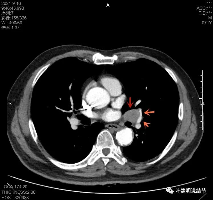 肺上有实性结节6mmx5mm是什么原因,肺上有1.7x1.8的实性结节该怎么办