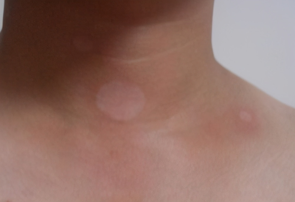 白癜风最快扩散方法,白癜风扩散期怎么治疗最快