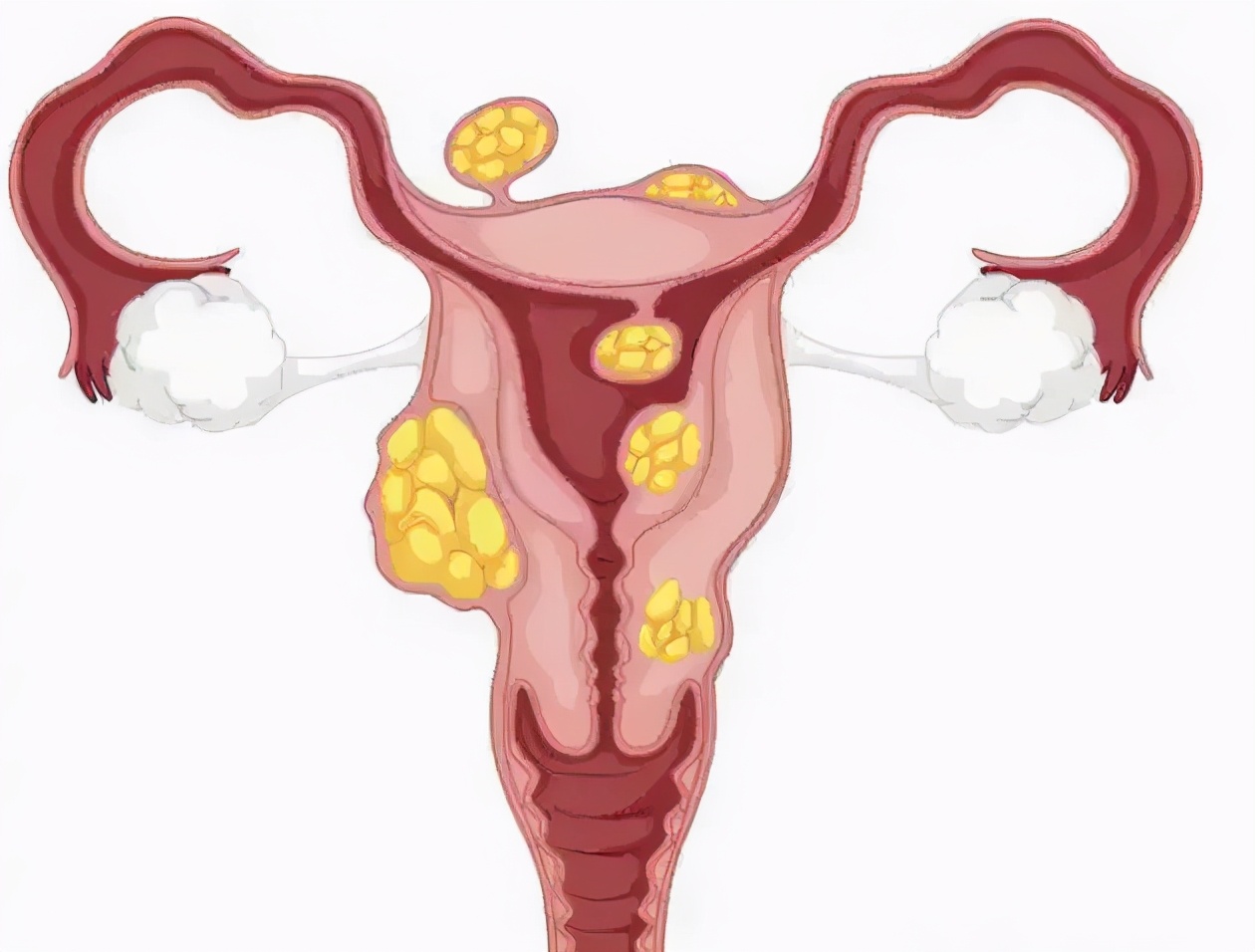 【豫健科普】子宫肌瘤患者仍可做“完整”的女人