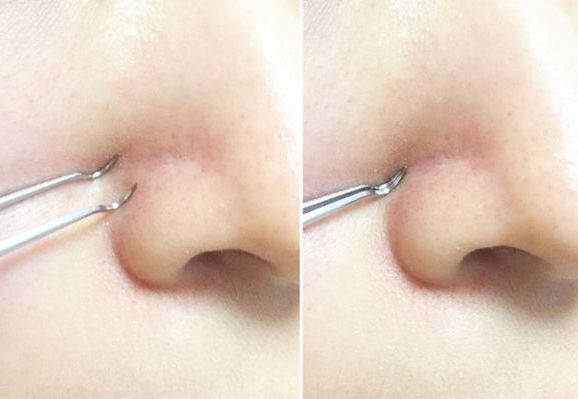 怎么去黑头黑头越来越少,黑头很多去黑头有效办法