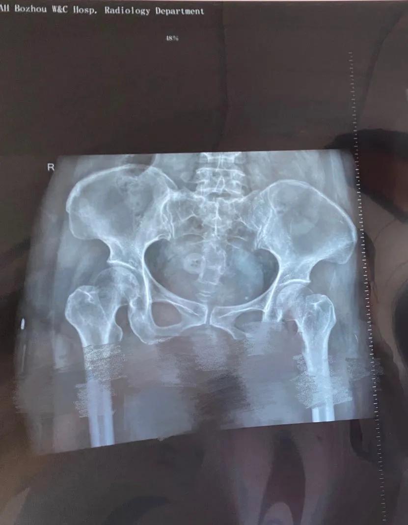 亳州市妇幼保健院妇产科开展宫腔镜手术为患者排忧解难