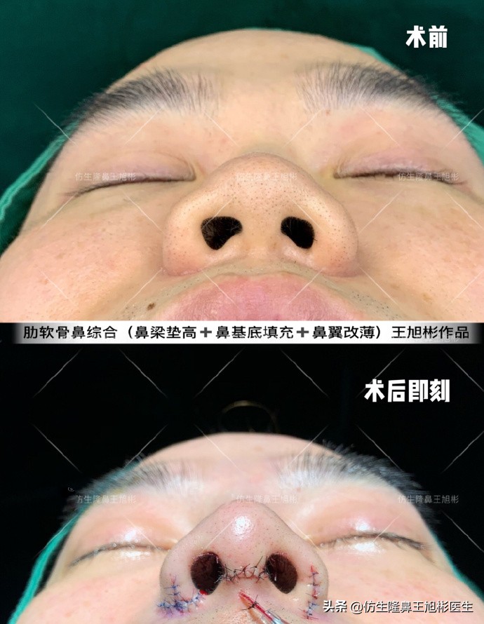 外切缩鼻翼的后遗症,外切鼻翼缩小会回弹吗