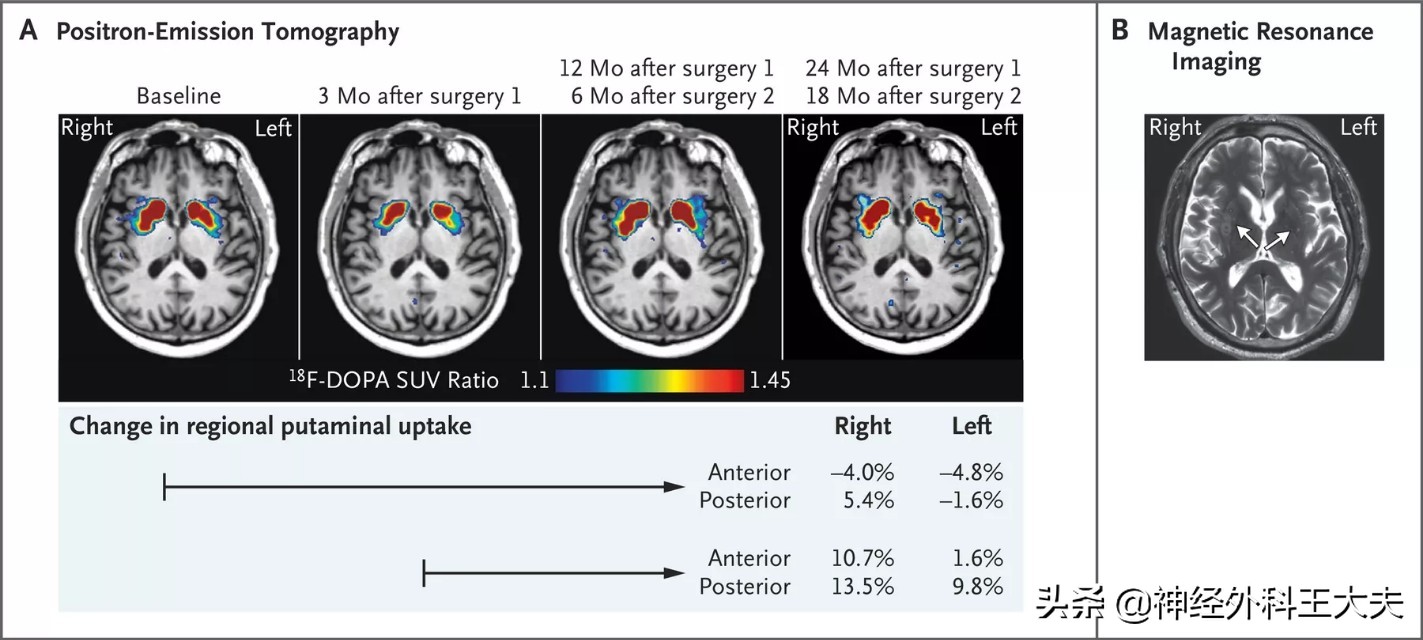 日本干细胞移植帕金森能治愈吗,北京干细胞移植治疗帕金森招募