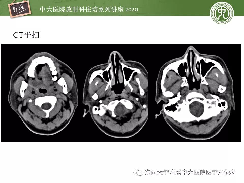颈动脉夹层的超声表现及漏诊分析,动脉夹层与夹层动脉瘤是一样的吗