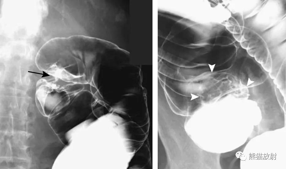 腹部影像图片大全,乙状直肠疼痛位置图片
