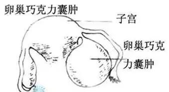 做了巧克力囊肿手术后会有血吗,手术中巧克力囊肿破裂