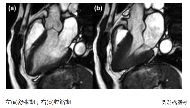 心电图t波改变是冠心病吗,心电图报告t波改变是冠心病吗