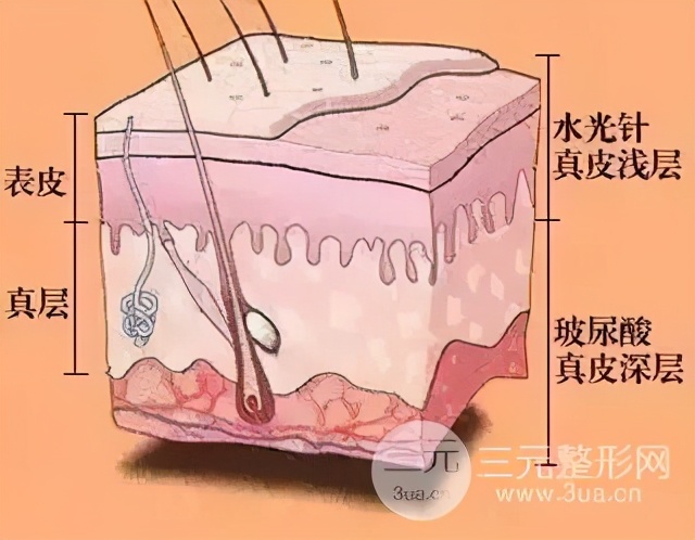 医美祛痘治疗有几种？怎么选择？超全科普告别痘肌