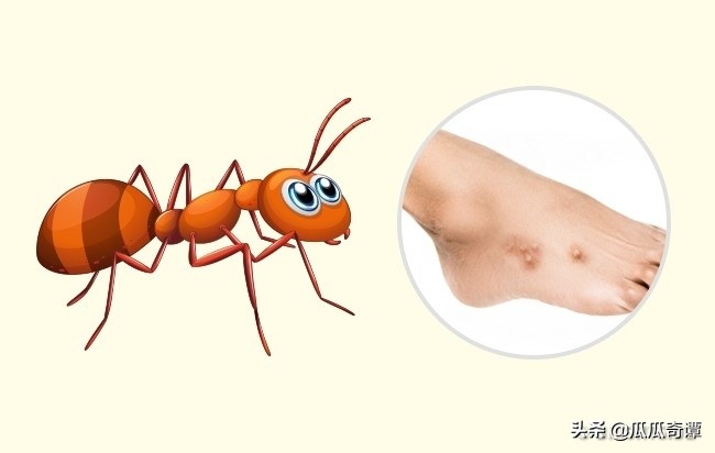 夏季蚊虫叮咬教你一招轻松解决,各种昆虫叮咬清晰图片对照表