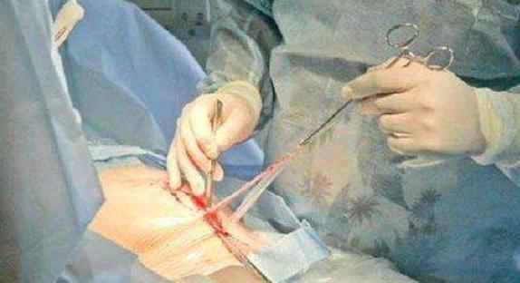 剖腹产第八天刀口表面有裂开,产妇生产剖腹产家人笑着说不同意