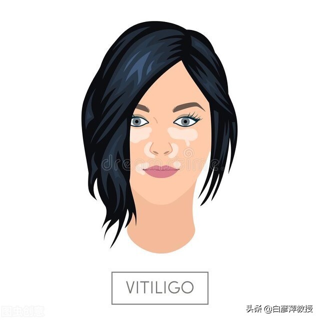 怎么才能辨别自己是否得了白癜风,皮肤科专家揭秘白癜风的发病原因