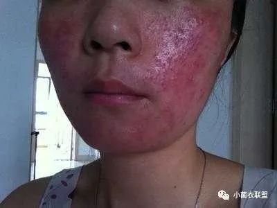 激素脸，皮肤萎缩，毛细血管扩张，色素沉着，怎么正确使用激素？