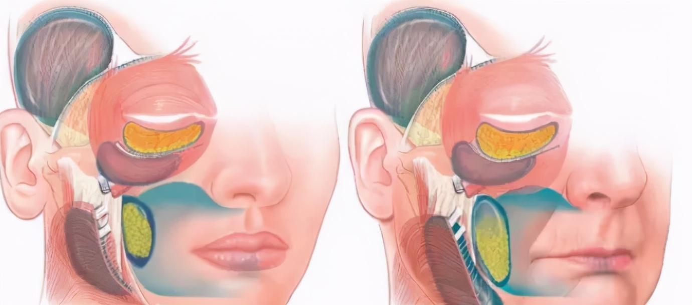 面部除皱手术原理都有哪些呢,面部除皱术发展史