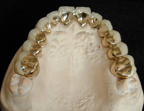 假牙最便宜一颗多少钱,假牙最贵