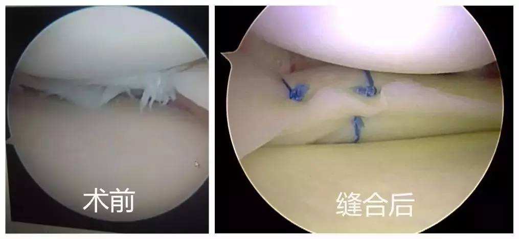 半月板被切除80%,半月板切除后还剩4分之一严重吗