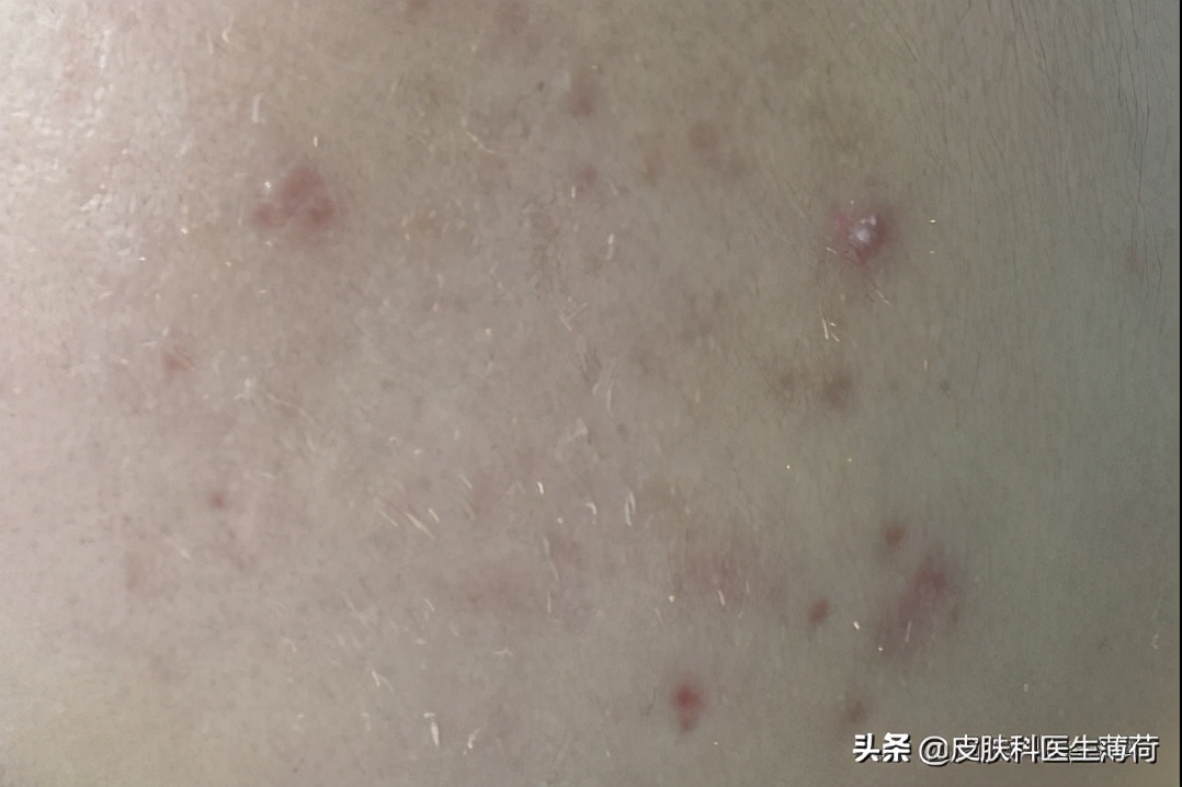 皮肤科医生怎么祛痘痘,皮肤科中医专家教你快速祛痘