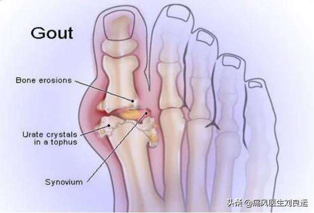脚痛不知道是不是痛风,脚很痛不知道是痛风还是脚筋痛