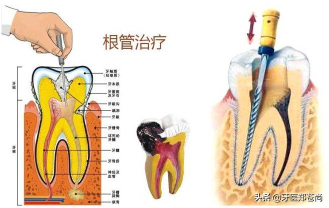 根管治疗一定要做二次吗,根管治疗能中途换医院吗
