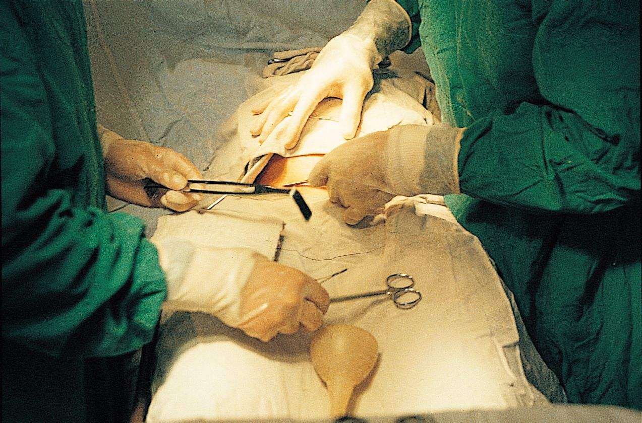 剖腹产手术把子宫拿出来,剖腹产手术需要从子宫取出胎儿吗