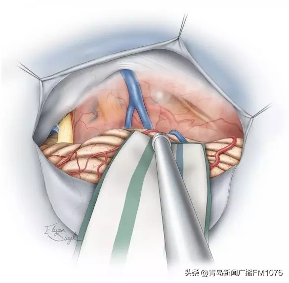 大妈脸不停抽搐,原是耳朵里藏了个大肿瘤,市立专家挑战高难度走位巧摘瘤