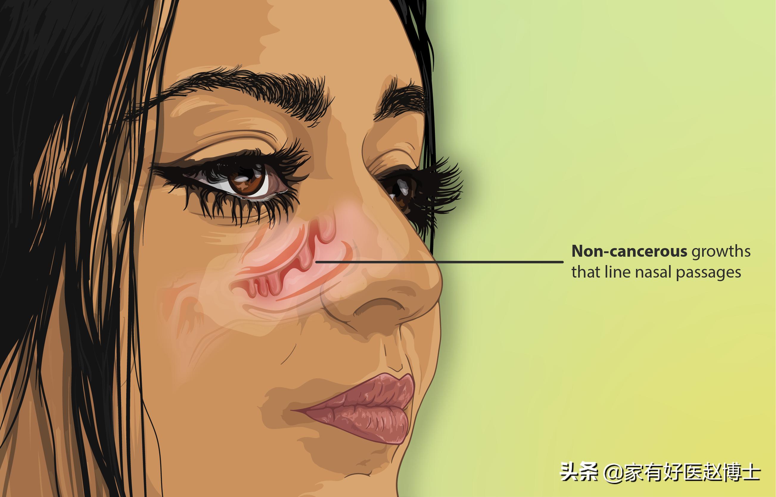 最常见5类息肉每个人都可能有，哪些无癌变风险，哪些需要切除？