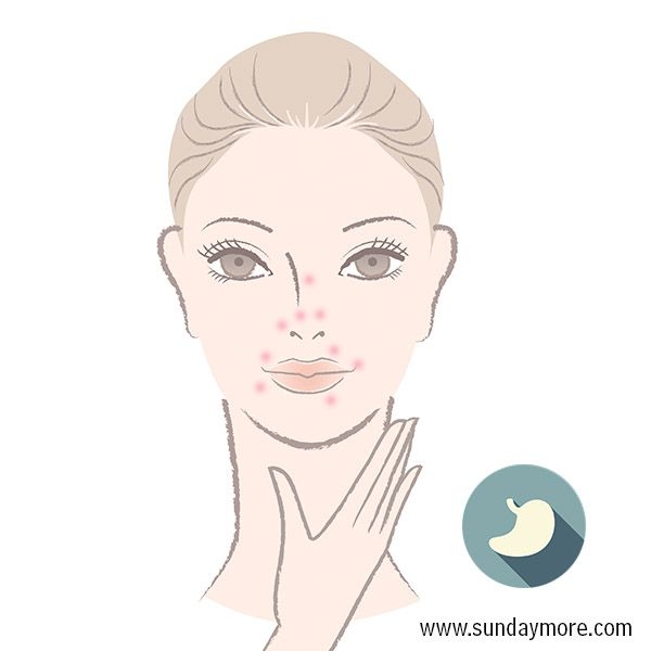 暗疮最好的消除方法 (暗疮印最佳治疗方法)