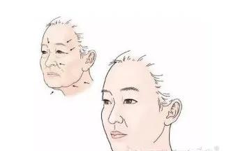 去皱针和玻尿酸哪个危害大,做热拉提祛法令纹还是玻尿酸好