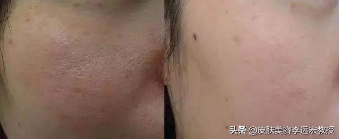 婴儿针是微针还是水光,bb针和水光针的区别