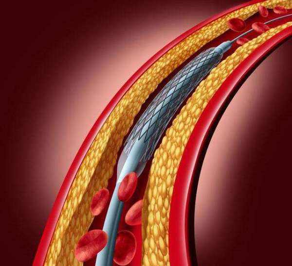 心肌缺血治疗最佳方法是什么,心肌缺血的最佳治疗方法是什么