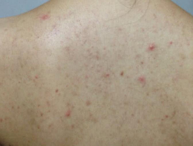 后背痘痘频发，又痒又难看，2物让你轻松告别痘痘背