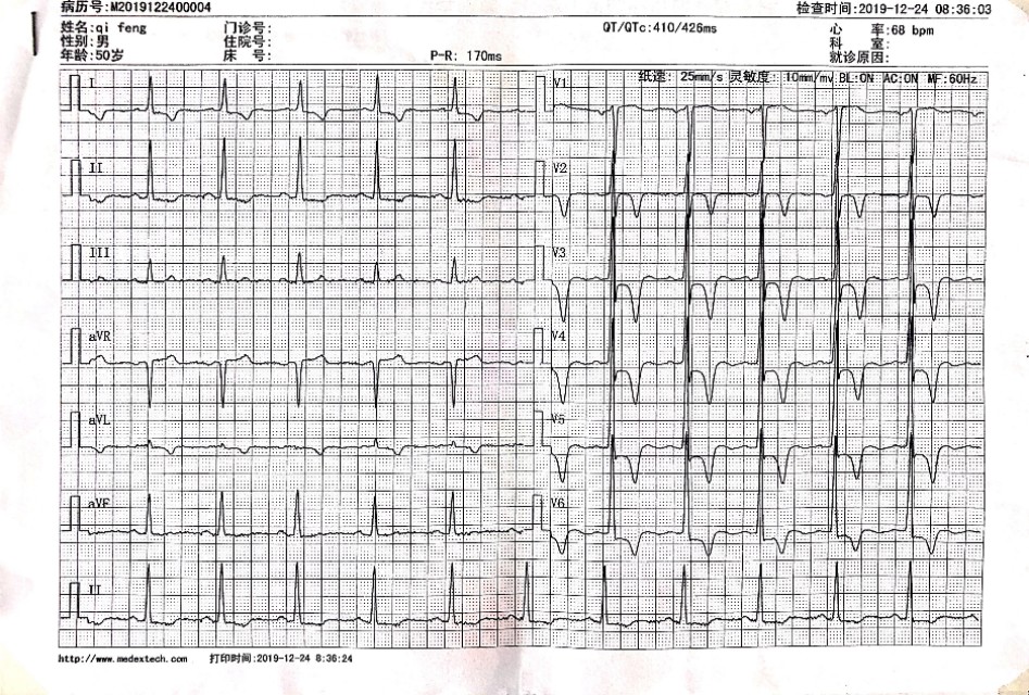 心电图部分t波低平性质待定,心电图部分t波低平能好么