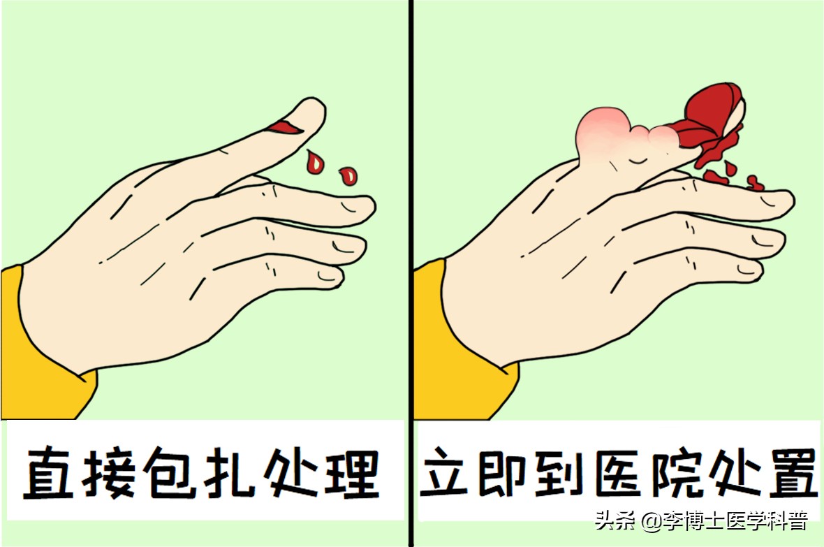 手外伤撕裂恢复最佳方法,手外伤的急救处理与断指的保存