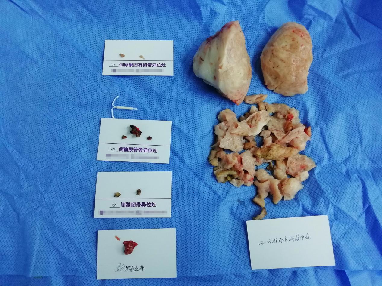 有一次剖腹产过第二次剖腹产会痛,熬过了剖宫产之后的痛