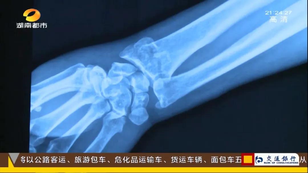 断骨手法复位视频,身怀绝技全集