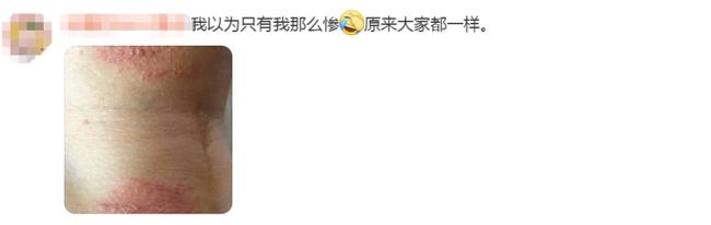 40岁女人脸被隐翅虫烧伤毁容吗,隐翅虫碰到脸上了是不是会毁容