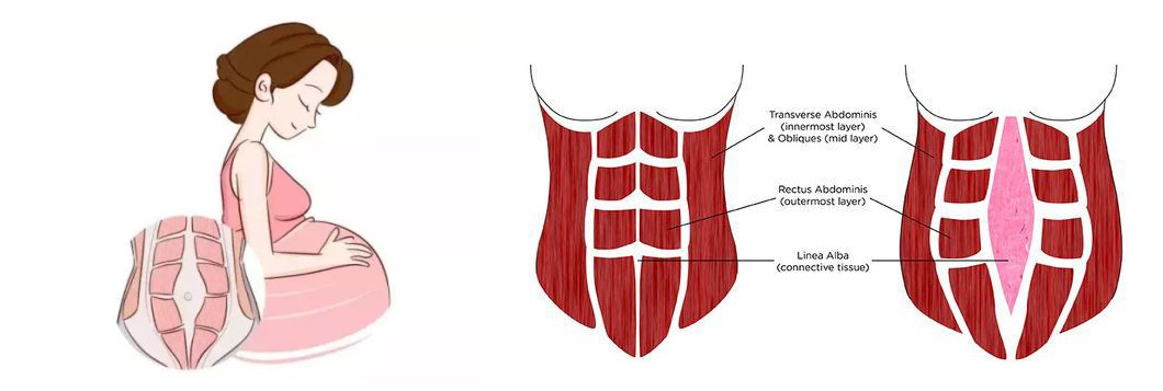 产后腰椎间盘突出正确锻炼方法,产后没有恢复好腰疼