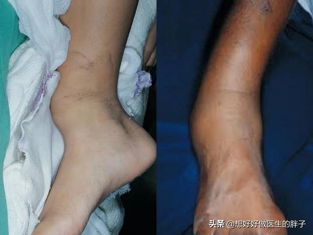 您重视过踝关节扭伤吗?扭伤3个月还不好,我们应该做点什么呢?