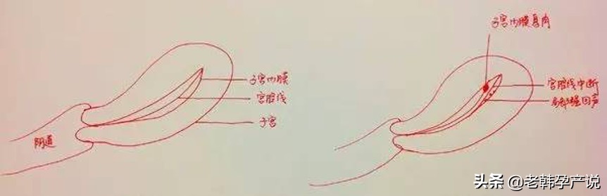 子宫内膜厚薄不均匀,子宫内膜薄该怎么办呢需要治疗吗