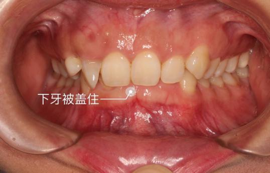 我戴牙套了日记,我戴了牙套两天牙齿松