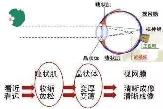 轴性近视通过训练可以恢复吗,300度的近视可以恢复吗