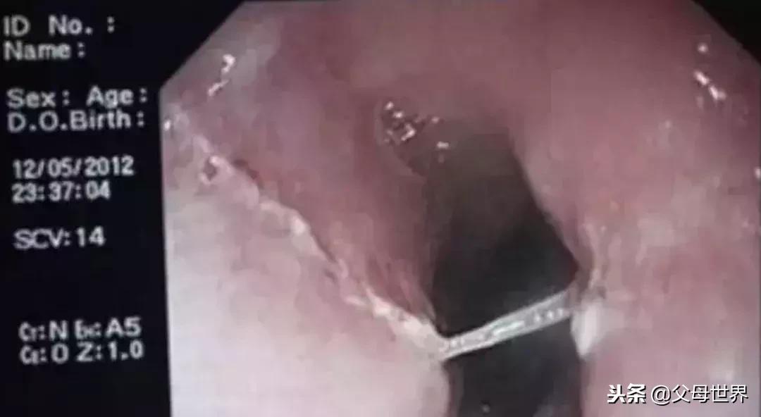 孩子被鱼刺卡喉了妈妈一定要知道,小孩鱼刺卡喉怎么急救