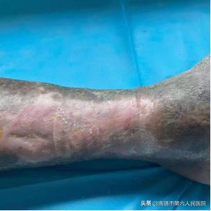 （南通发布）多科协作显神效，八旬老汉的老烂腿终于治愈了