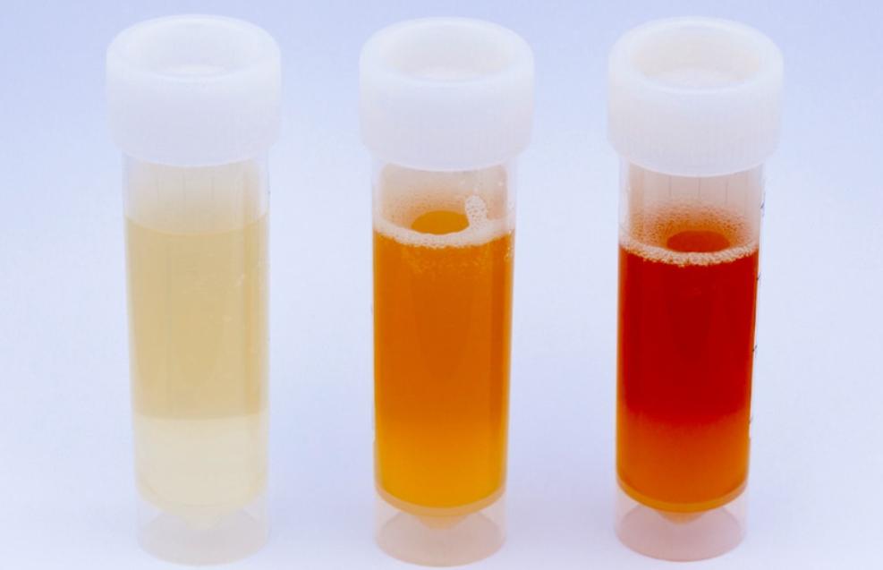 发现小便颜色不对,尿尿颜色不对查什么科