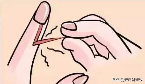 手指长倒刺怎么办别撕,手指撕倒刺指头肿了怎么办