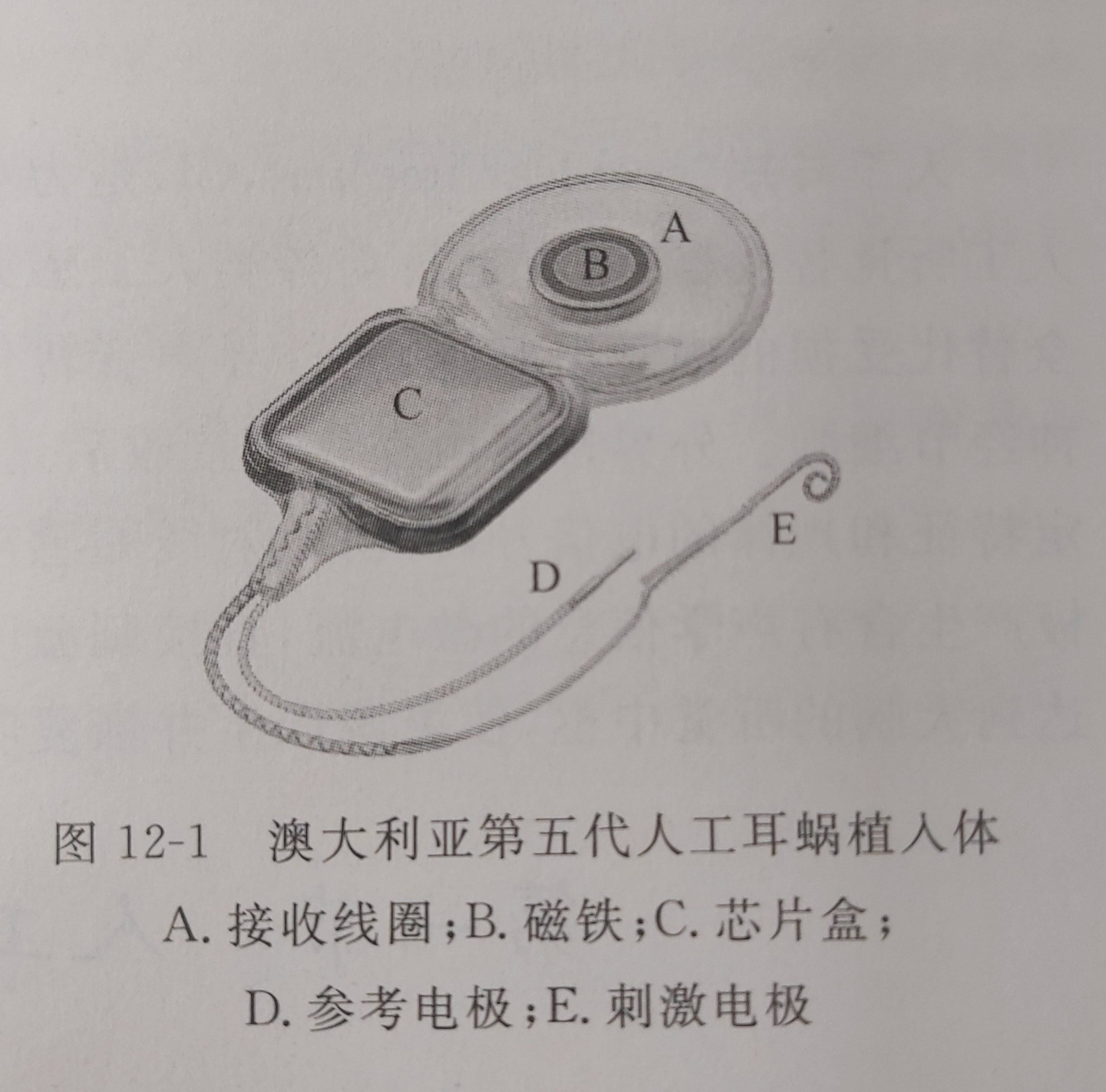 人工耳蜗第九代,双耳65分贝带助听器还是人工耳蜗