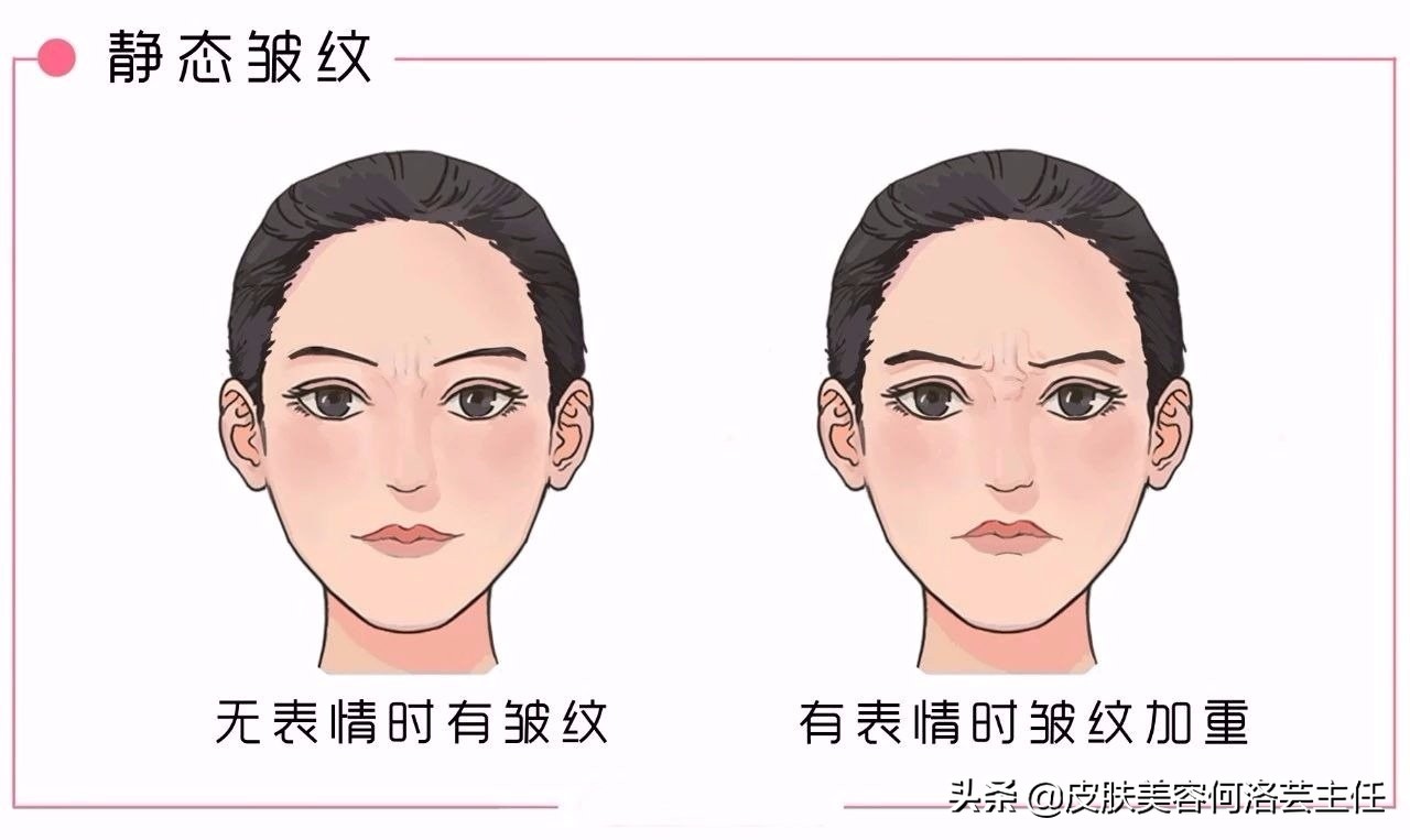 脸上有皱纹最快的去皱方法,脸上的皱纹用什么办法去皱效果好